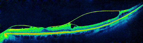 ERM OCT Composite
Multiple OCT scan Composite to show ERM
Keywords: Vitreous Macular Traction;VMT;Macular Pucker;MP
