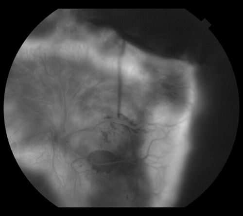 PDR w/TRD
PDR w/heme and traction retinal detachment
Keywords: PDR;NV;Traction Retinal Detachment;vitreous hemorrhage