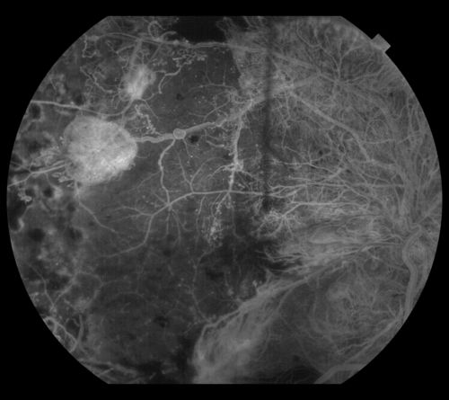 NVE OD
Keywords: Neovasc;diabetes