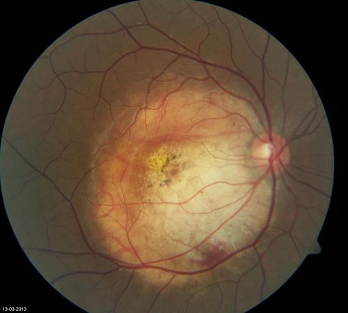 Choroidal Osteoma
Young girl with vision loss from osteoma.
Palabras clave: may2013