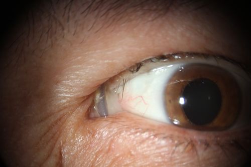 Silicon implant is seen inserted in to the superior lid skin
Patient with several months of discomfort, discharge, FB sensation after scleral buckle surgery.
Keywords: buckle extrusion, 
