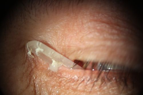 Implant removed from the skin tunel
the extruded piece of silicon is seen after removal from the skin tunnel. It is still attached to the sclera, through a conjunctival hole
Keywords: buckle extrusion, 