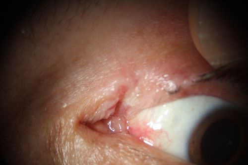 Deep skin tunel remains after silicon buckle removed
superior lid skin tunnel made by 2 years of erosion of the buckle
Keywords: buckle extrusion, 