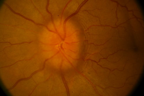 Papilledema unspecified 
Keywords: papilledema,october2013