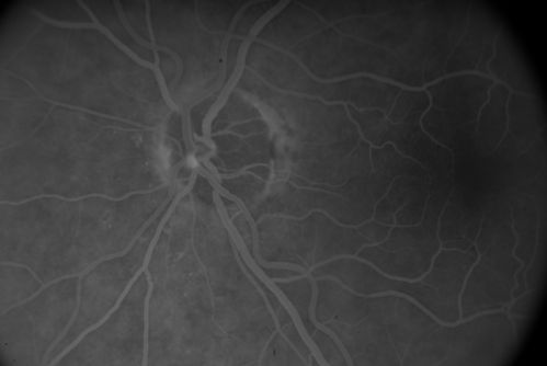 Embolic CRAO Mid
