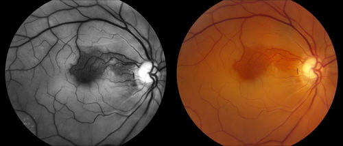 Central Retinal Artery Occlusion
Central Retinal Artery Occlusion with cilio artery perfusion. 
Keywords: July2014
