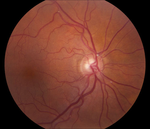 Hollenhorst Plaque
Multile plaque spots in a middle aged patient. 
Keywords: hollenhorst plaque;august2014
