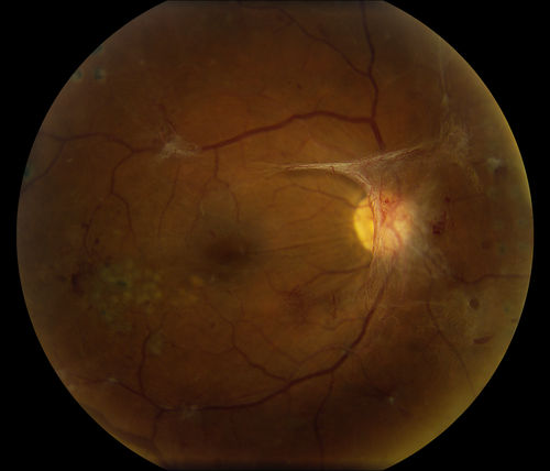 NVD
Diabetic patient with NVD and NVE
Keywords: NVD;NVD;PDR;august2014