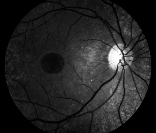 Red Free Macular Hole 
Full Thickness Macular Hole
Keywords: Macular Hole;red free;Fundus Photo