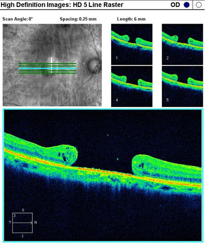 OCT Macular Hole 
Macular Hole OCT
Keywords: OCT