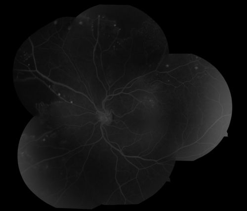 Coat's Disease
47 year old african-american male, presented under the assumption he had Sarcoidosis but appears more like Coat's Disease
Palabras clave: Coat's Disease