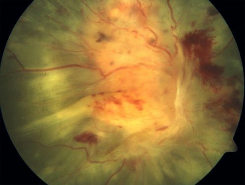 Retina_28829.jpg