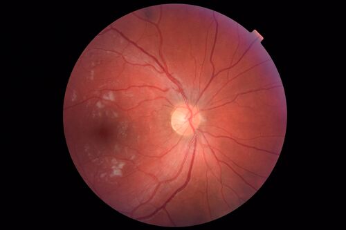 Cotton Wool Spots - Severe Anemia - Acute Lymphocytic Leukemia
23 year old just diagnosed with anemia and acute lymphocytic leukemia 
: If he covers each eye neither eye is lacking.  When he looks to the left he gets double vision when he looks to the right his vision is fine.  This started about 2 weeks ago.  Since it started it has been variable.  He is on a bunch of medications for leukemia and he might be having high sugars.  He noticed the vision change after his first blood transfusion in the hospital.  He is currently very anemic.  
VA OD: sc20/20 NscJ1+
VA OS: sc20/20 NscJ1+
