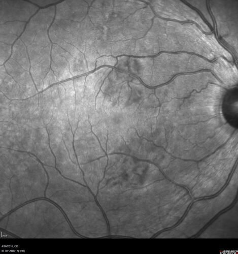 Cotton Wool Spots - Severe Anemia - Acute Lymphocytic Leukemia
23 year old just diagnosed with anemia and acute lymphocytic leukemia 
: If he covers each eye neither eye is lacking.  When he looks to the left he gets double vision when he looks to the right his vision is fine.  This started about 2 weeks ago.  Since it started it has been variable.  He is on a bunch of medications for leukemia and he might be having high sugars.  He noticed the vision change after his first blood transfusion in the hospital.  He is currently very anemic.  
VA OD: sc20/20 NscJ1+
VA OS: sc20/20 NscJ1+
