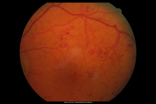Traction retinal detachment both eyes.  Proliferative Diabetic Retinopathy
40 year old man came in with vision loss OD and rubeosis in both eyes.  Was treated with Avastin monthly and laser OD then lost to follow-up for 6 months.  Came back with table top traction in the left macula (second set of images).  Vision had dropped OS from 20/20 to HM.  He had PPV ERM peel OS and vision improved to 5/200.  
OD stabilized to 20/20 with PRP laser.  Now on 6 month checks.
