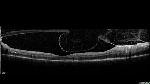Traction retinal detachment both eyes.  Proliferative Diabetic Retinopathy
40 year old man came in with vision loss OD and rubeosis in both eyes.  Was treated with Avastin monthly and laser OD then lost to follow-up for 6 months.  Came back with table top traction in the left macula (second set of images).  Vision had dropped OS from 20/20 to HM.  He had PPV ERM peel OS and vision improved to 5/200.  
OD stabilized to 20/20 with PRP laser.  Now on 6 month checks.
