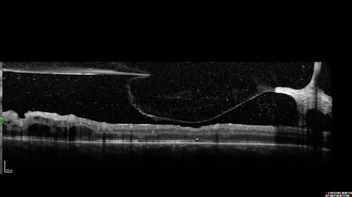 Traction retinal detachment both eyes.  Proliferative Diabetic Retinopathy
40 year old man came in with vision loss OD and rubeosis in both eyes.  Was treated with Avastin monthly and laser OD then lost to follow-up for 6 months.  Came back with table top traction in the left macula (second set of images).  Vision had dropped OS from 20/20 to HM.  He had PPV ERM peel OS and vision improved to 5/200.  
OD stabilized to 20/20 with PRP laser.  Now on 6 month checks.
