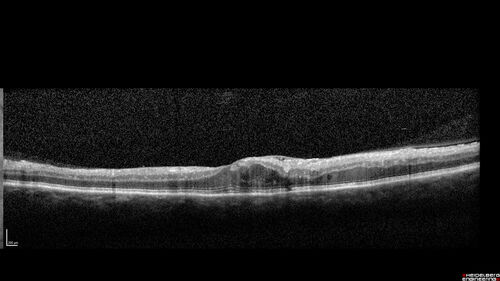 Traction retinal detachment both eyes.  Proliferative Diabetic Retinopathy
40 year old man came in with vision loss OD and rubeosis in both eyes.  Was treated with Avastin monthly and laser OD then lost to follow-up for 6 months.  Came back with table top traction in the left macula (second set of images).  Vision had dropped OS from 20/20 to HM.  He had PPV ERM peel OS and vision improved to 5/200.  
OD stabilized to 20/20 with PRP laser.  Now on 6 month checks.
