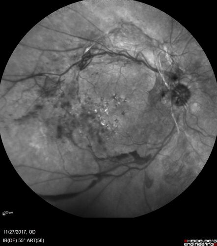 Traction retinal detachment both eyes.  Proliferative Diabetic Retinopathy
40 year old man came in with vision loss OD and rubeosis in both eyes.  Was treated with Avastin monthly and laser OD then lost to follow-up for 6 months.  Came back with table top traction in the left macula (second set of images).  Vision had dropped OS from 20/20 to HM.  He had PPV ERM peel OS and vision improved to 5/200.  
OD stabilized to 20/20 with PRP laser.  Now on 6 month checks.
