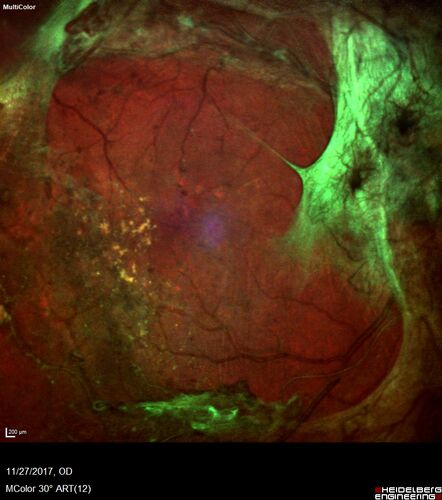 Traction retinal detachment both eyes.  Proliferative Diabetic Retinopathy
40 year old man came in with vision loss OD and rubeosis in both eyes.  Was treated with Avastin monthly and laser OD then lost to follow-up for 6 months.  Came back with table top traction in the left macula (second set of images).  Vision had dropped OS from 20/20 to HM.  He had PPV ERM peel OS and vision improved to 5/200.  
OD stabilized to 20/20 with PRP laser.  Now on 6 month checks.
