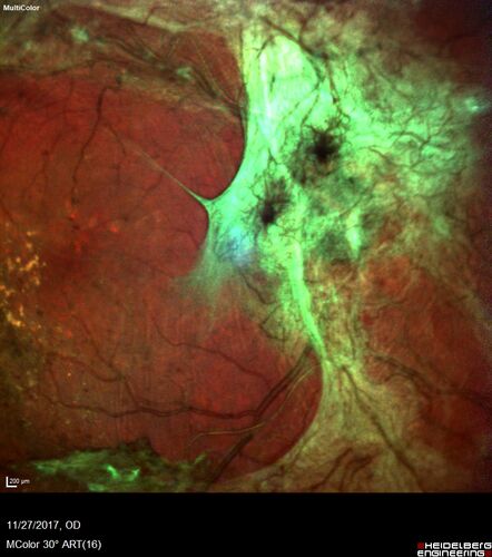 Traction retinal detachment both eyes.  Proliferative Diabetic Retinopathy
40 year old man came in with vision loss OD and rubeosis in both eyes.  Was treated with Avastin monthly and laser OD then lost to follow-up for 6 months.  Came back with table top traction in the left macula (second set of images).  Vision had dropped OS from 20/20 to HM.  He had PPV ERM peel OS and vision improved to 5/200.  
OD stabilized to 20/20 with PRP laser.  Now on 6 month checks.
