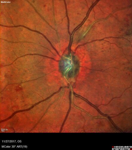 Traction retinal detachment both eyes.  Proliferative Diabetic Retinopathy
40 year old man came in with vision loss OD and rubeosis in both eyes.  Was treated with Avastin monthly and laser OD then lost to follow-up for 6 months.  Came back with table top traction in the left macula (second set of images).  Vision had dropped OS from 20/20 to HM.  He had PPV ERM peel OS and vision improved to 5/200.  
OD stabilized to 20/20 with PRP laser.  Now on 6 month checks.
