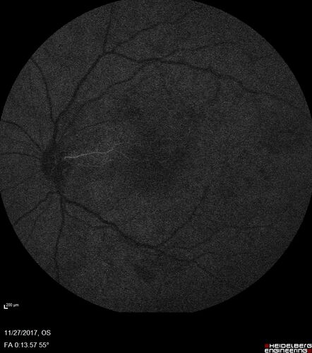 Traction retinal detachment both eyes.  Proliferative Diabetic Retinopathy
40 year old man came in with vision loss OD and rubeosis in both eyes.  Was treated with Avastin monthly and laser OD then lost to follow-up for 6 months.  Came back with table top traction in the left macula (second set of images).  Vision had dropped OS from 20/20 to HM.  He had PPV ERM peel OS and vision improved to 5/200.  
OD stabilized to 20/20 with PRP laser.  Now on 6 month checks.
