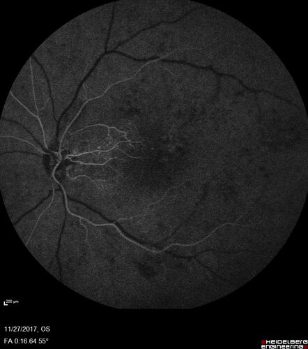 Traction retinal detachment both eyes.  Proliferative Diabetic Retinopathy
40 year old man came in with vision loss OD and rubeosis in both eyes.  Was treated with Avastin monthly and laser OD then lost to follow-up for 6 months.  Came back with table top traction in the left macula (second set of images).  Vision had dropped OS from 20/20 to HM.  He had PPV ERM peel OS and vision improved to 5/200.  
OD stabilized to 20/20 with PRP laser.  Now on 6 month checks.
