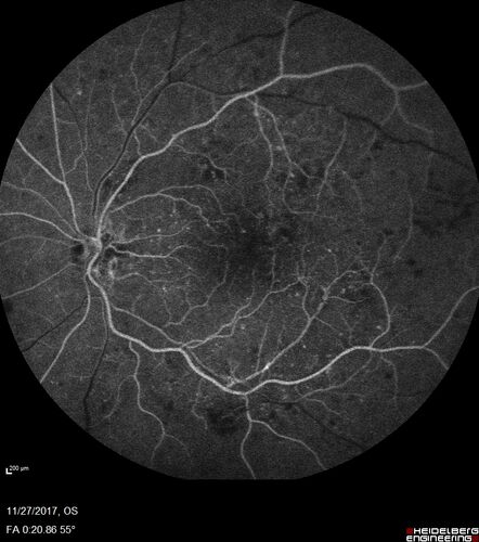 Traction retinal detachment both eyes.  Proliferative Diabetic Retinopathy
40 year old man came in with vision loss OD and rubeosis in both eyes.  Was treated with Avastin monthly and laser OD then lost to follow-up for 6 months.  Came back with table top traction in the left macula (second set of images).  Vision had dropped OS from 20/20 to HM.  He had PPV ERM peel OS and vision improved to 5/200.  
OD stabilized to 20/20 with PRP laser.  Now on 6 month checks.
