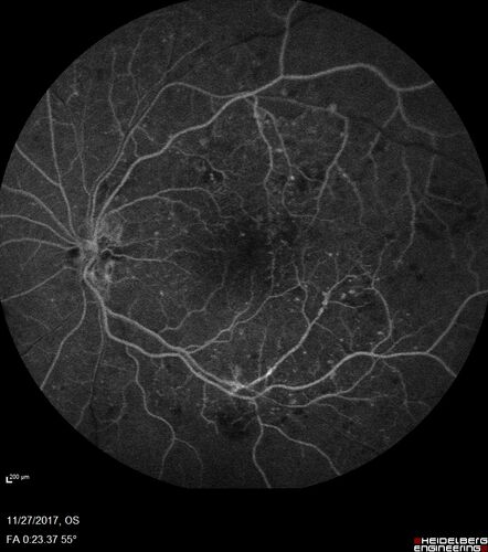 Traction retinal detachment both eyes.  Proliferative Diabetic Retinopathy
40 year old man came in with vision loss OD and rubeosis in both eyes.  Was treated with Avastin monthly and laser OD then lost to follow-up for 6 months.  Came back with table top traction in the left macula (second set of images).  Vision had dropped OS from 20/20 to HM.  He had PPV ERM peel OS and vision improved to 5/200.  
OD stabilized to 20/20 with PRP laser.  Now on 6 month checks.
