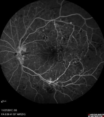 Traction retinal detachment both eyes.  Proliferative Diabetic Retinopathy
40 year old man came in with vision loss OD and rubeosis in both eyes.  Was treated with Avastin monthly and laser OD then lost to follow-up for 6 months.  Came back with table top traction in the left macula (second set of images).  Vision had dropped OS from 20/20 to HM.  He had PPV ERM peel OS and vision improved to 5/200.  
OD stabilized to 20/20 with PRP laser.  Now on 6 month checks.
