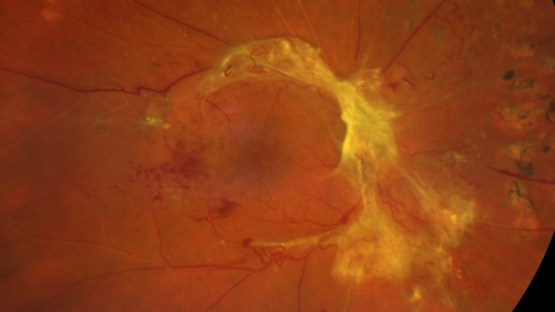 Traction retinal detachment both eyes.  Proliferative Diabetic Retinopathy
40 year old man came in with vision loss OD and rubeosis in both eyes.  Was treated with Avastin monthly and laser OD then lost to follow-up for 6 months.  Came back with table top traction in the left macula (second set of images).  Vision had dropped OS from 20/20 to HM.  He had PPV ERM peel OS and vision improved to 5/200.  
OD stabilized to 20/20 with PRP laser.  Now on 6 month checks.
