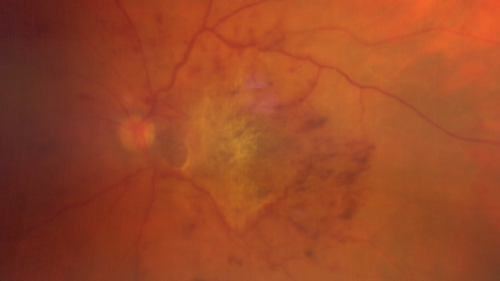 Traction retinal detachment both eyes.  Proliferative Diabetic Retinopathy
40 year old man came in with vision loss OD and rubeosis in both eyes.  Was treated with Avastin monthly and laser OD then lost to follow-up for 6 months.  Came back with table top traction in the left macula (second set of images).  Vision had dropped OS from 20/20 to HM.  He had PPV ERM peel OS and vision improved to 5/200.  
OD stabilized to 20/20 with PRP laser.  Now on 6 month checks.
