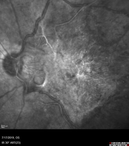 Traction retinal detachment both eyes.  Proliferative Diabetic Retinopathy
40 year old man came in with vision loss OD and rubeosis in both eyes.  Was treated with Avastin monthly and laser OD then lost to follow-up for 6 months.  Came back with table top traction in the left macula (second set of images).  Vision had dropped OS from 20/20 to HM.  He had PPV ERM peel OS and vision improved to 5/200.  
OD stabilized to 20/20 with PRP laser.  Now on 6 month checks.
