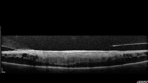 Traction retinal detachment both eyes.  Proliferative Diabetic Retinopathy
40 year old man came in with vision loss OD and rubeosis in both eyes.  Was treated with Avastin monthly and laser OD then lost to follow-up for 6 months.  Came back with table top traction in the left macula (second set of images).  Vision had dropped OS from 20/20 to HM.  He had PPV ERM peel OS and vision improved to 5/200.  
OD stabilized to 20/20 with PRP laser.  Now on 6 month checks.
