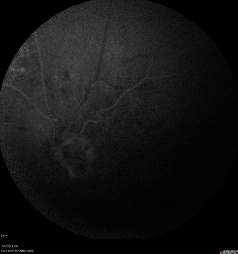Traction retinal detachment both eyes.  Proliferative Diabetic Retinopathy
40 year old man came in with vision loss OD and rubeosis in both eyes.  Was treated with Avastin monthly and laser OD then lost to follow-up for 6 months.  Came back with table top traction in the left macula (second set of images).  Vision had dropped OS from 20/20 to HM.  He had PPV ERM peel OS and vision improved to 5/200.  
OD stabilized to 20/20 with PRP laser.  Now on 6 month checks.
