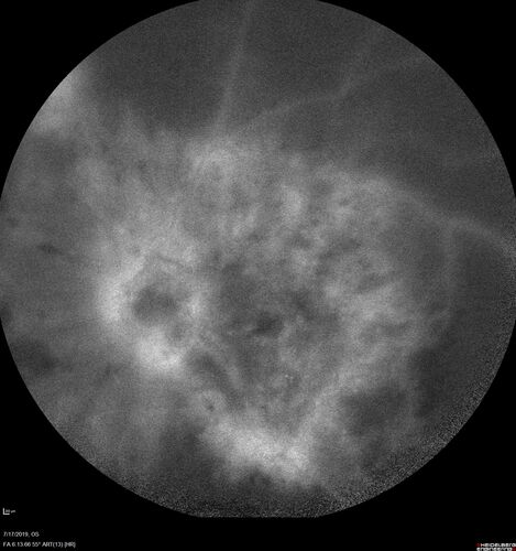 Traction retinal detachment both eyes.  Proliferative Diabetic Retinopathy
40 year old man came in with vision loss OD and rubeosis in both eyes.  Was treated with Avastin monthly and laser OD then lost to follow-up for 6 months.  Came back with table top traction in the left macula (second set of images).  Vision had dropped OS from 20/20 to HM.  He had PPV ERM peel OS and vision improved to 5/200.  
OD stabilized to 20/20 with PRP laser.  Now on 6 month checks.
