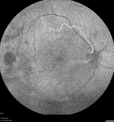 PDR and Vitreous hemorrhage - Second FA is following PRP laser
42 year old man (date 2018): Prior to 2 months ago the vision in the right eye was good.  This started with a glob in the vision and then the vision got better.  Then the string came back down and is getting bigger and bigger.  The last time he had bleeding in the left eye he had surgery in 2009.  The left eye is now doing OK other than there is a cataract.  The right eye had some laser treatment done in 2009.  The vitrectomy and laser were done at William Beaumont.  
VA OD: sc3'/200 NscUnable
VA OS: sc20/40 NscJ2-1
