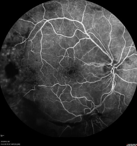 PDR and Vitreous hemorrhage - Second FA is following PRP laser
42 year old man (date 2018): Prior to 2 months ago the vision in the right eye was good.  This started with a glob in the vision and then the vision got better.  Then the string came back down and is getting bigger and bigger.  The last time he had bleeding in the left eye he had surgery in 2009.  The left eye is now doing OK other than there is a cataract.  The right eye had some laser treatment done in 2009.  The vitrectomy and laser were done at William Beaumont.  
VA OD: sc3'/200 NscUnable
VA OS: sc20/40 NscJ2-1

