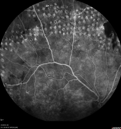 PDR and Vitreous hemorrhage - Second FA is following PRP laser
42 year old man (date 2018): Prior to 2 months ago the vision in the right eye was good.  This started with a glob in the vision and then the vision got better.  Then the string came back down and is getting bigger and bigger.  The last time he had bleeding in the left eye he had surgery in 2009.  The left eye is now doing OK other than there is a cataract.  The right eye had some laser treatment done in 2009.  The vitrectomy and laser were done at William Beaumont.  
VA OD: sc3'/200 NscUnable
VA OS: sc20/40 NscJ2-1
