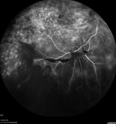 PDR and Vitreous hemorrhage - Second FA is following PRP laser
42 year old man (date 2018): Prior to 2 months ago the vision in the right eye was good.  This started with a glob in the vision and then the vision got better.  Then the string came back down and is getting bigger and bigger.  The last time he had bleeding in the left eye he had surgery in 2009.  The left eye is now doing OK other than there is a cataract.  The right eye had some laser treatment done in 2009.  The vitrectomy and laser were done at William Beaumont.  
VA OD: sc3'/200 NscUnable
VA OS: sc20/40 NscJ2-1
