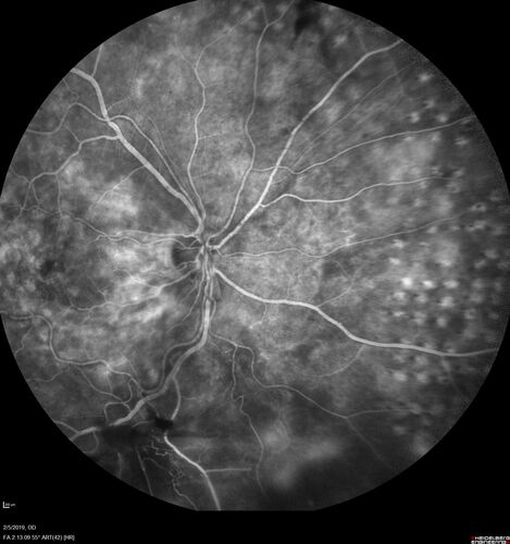 PDR and Vitreous hemorrhage - Second FA is following PRP laser
42 year old man (date 2018): Prior to 2 months ago the vision in the right eye was good.  This started with a glob in the vision and then the vision got better.  Then the string came back down and is getting bigger and bigger.  The last time he had bleeding in the left eye he had surgery in 2009.  The left eye is now doing OK other than there is a cataract.  The right eye had some laser treatment done in 2009.  The vitrectomy and laser were done at William Beaumont.  
VA OD: sc3'/200 NscUnable
VA OS: sc20/40 NscJ2-1
