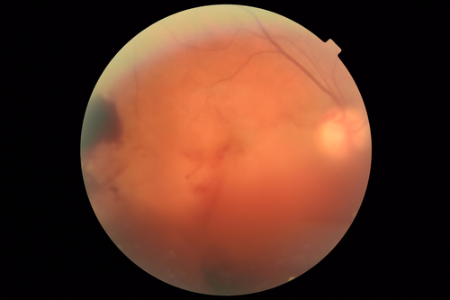 PDR and Vitreous hemorrhage - Second FA is following PRP laser
42 year old man (date 2018): Prior to 2 months ago the vision in the right eye was good.  This started with a glob in the vision and then the vision got better.  Then the string came back down and is getting bigger and bigger.  The last time he had bleeding in the left eye he had surgery in 2009.  The left eye is now doing OK other than there is a cataract.  The right eye had some laser treatment done in 2009.  The vitrectomy and laser were done at William Beaumont.  
VA OD: sc3'/200 NscUnable
VA OS: sc20/40 NscJ2-1
