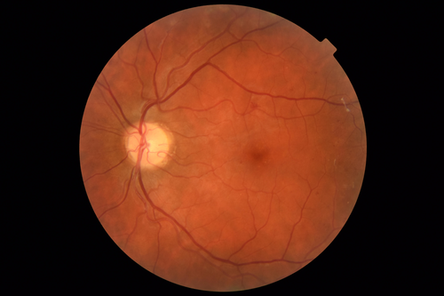 PDR and Vitreous hemorrhage - Second FA is following PRP laser
42 year old man (date 2018): Prior to 2 months ago the vision in the right eye was good.  This started with a glob in the vision and then the vision got better.  Then the string came back down and is getting bigger and bigger.  The last time he had bleeding in the left eye he had surgery in 2009.  The left eye is now doing OK other than there is a cataract.  The right eye had some laser treatment done in 2009.  The vitrectomy and laser were done at William Beaumont.  
VA OD: sc3'/200 NscUnable
VA OS: sc20/40 NscJ2-1
