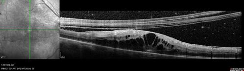 PDR and Vitreous hemorrhage - Second FA is following PRP laser
42 year old man (date 2018): Prior to 2 months ago the vision in the right eye was good.  This started with a glob in the vision and then the vision got better.  Then the string came back down and is getting bigger and bigger.  The last time he had bleeding in the left eye he had surgery in 2009.  The left eye is now doing OK other than there is a cataract.  The right eye had some laser treatment done in 2009.  The vitrectomy and laser were done at William Beaumont.  
VA OD: sc3'/200 NscUnable
VA OS: sc20/40 NscJ2-1
