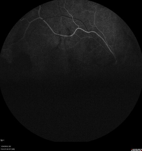 PDR and Vitreous hemorrhage - Second FA is following PRP laser
42 year old man (date 2018): Prior to 2 months ago the vision in the right eye was good.  This started with a glob in the vision and then the vision got better.  Then the string came back down and is getting bigger and bigger.  The last time he had bleeding in the left eye he had surgery in 2009.  The left eye is now doing OK other than there is a cataract.  The right eye had some laser treatment done in 2009.  The vitrectomy and laser were done at William Beaumont.  
VA OD: sc3'/200 NscUnable
VA OS: sc20/40 NscJ2-1
