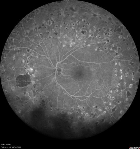 PDR and Vitreous hemorrhage - Second FA is following PRP laser
42 year old man (date 2018): Prior to 2 months ago the vision in the right eye was good.  This started with a glob in the vision and then the vision got better.  Then the string came back down and is getting bigger and bigger.  The last time he had bleeding in the left eye he had surgery in 2009.  The left eye is now doing OK other than there is a cataract.  The right eye had some laser treatment done in 2009.  The vitrectomy and laser were done at William Beaumont.  
VA OD: sc3'/200 NscUnable
VA OS: sc20/40 NscJ2-1
