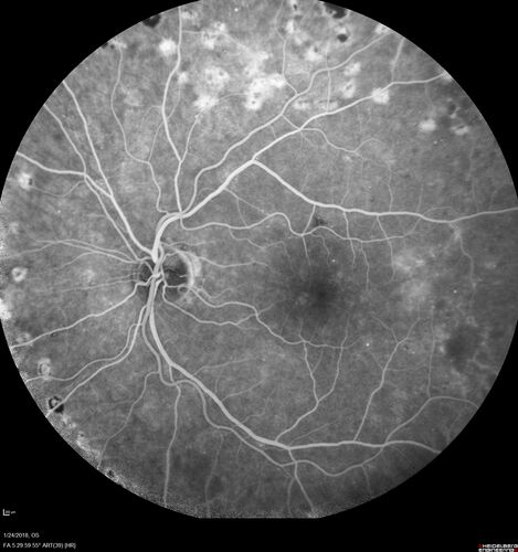 PDR and Vitreous hemorrhage - Second FA is following PRP laser
42 year old man (date 2018): Prior to 2 months ago the vision in the right eye was good.  This started with a glob in the vision and then the vision got better.  Then the string came back down and is getting bigger and bigger.  The last time he had bleeding in the left eye he had surgery in 2009.  The left eye is now doing OK other than there is a cataract.  The right eye had some laser treatment done in 2009.  The vitrectomy and laser were done at William Beaumont.  
VA OD: sc3'/200 NscUnable
VA OS: sc20/40 NscJ2-1
