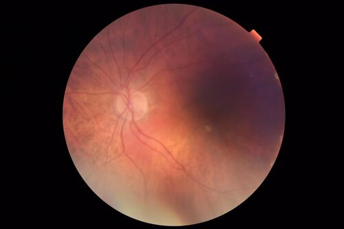 Subretinal Fluid - Inferior to the Nerve - Probable occult nerve pit
82 year old female. History of visual 