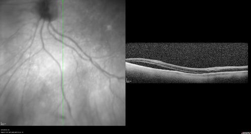 Subretinal Fluid - Inferior to the Nerve - Probable occult nerve pit
82 year old female. History of visual 